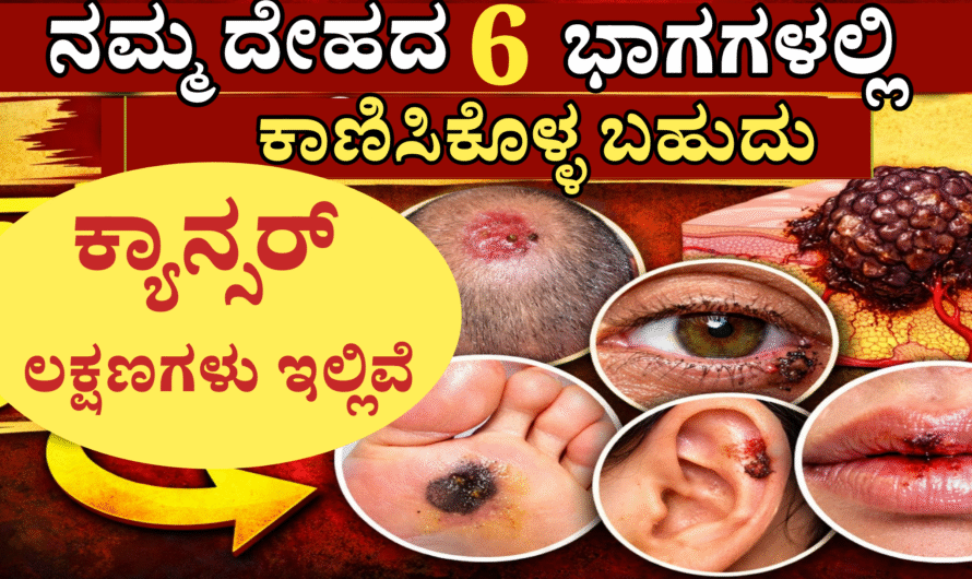 Cancer ನಮ್ಮ ದೇಹದ ಈ 6 ಭಾಗಗಳಲ್ಲಿ ಕಾಣಿಸಿಕೊಳ್ಳಬಹುದು ಚರ್ಮದ ಕ್ಯಾನ್ಸರ್ ಲಕ್ಷಣಗಳು!